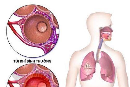 Dưỡng âm thanh phế thang - phương thuốc quý hồi phục tốt sau viêm phổi