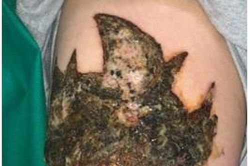 Dễ xăm, khó xóa