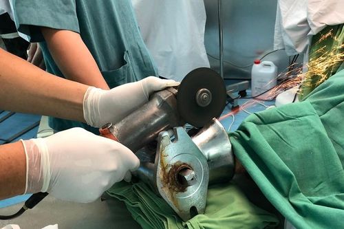 Bác sĩ cưa máy xay thịt cứu bàn tay người phụ nữ bị nghiền nát