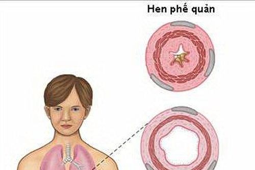 Nguyên nhân và cách phòng hen phế quản