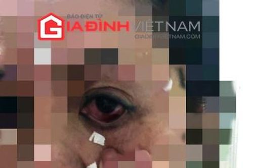 Hà Nội: Bệnh nhân có nguy cơ mù khi cấy chỉ tại Phòng khám tư?