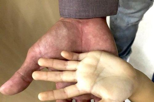 Bé gái suýt mất mạng vì thiếu máu do uống quá nhiều sữa tươi mỗi ngày
