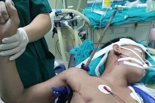 Nam thanh niên bị thanh sắt đâm xuyên nách, chảy máu nhiều