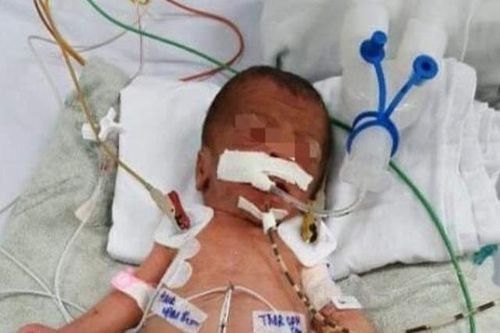 Tự dùng kéo cắt rốn ở nhà, bé sơ sinh bị uốn ván nguy kịch