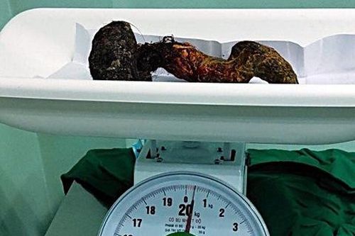 Bình Thuận: Tiến hành phẫu thuật cho cô bé 10 tuổi có gần 1kg tóc trong bụng