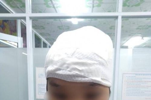 Bé gái bị lột toàn bộ mái tóc do cuốn vào máy cưa nước đá được xuất viện