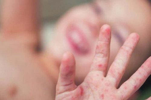 Liên tiếp trẻ em nhập viện, bác sĩ cảnh báo tay chân miệng có thể bùng phát