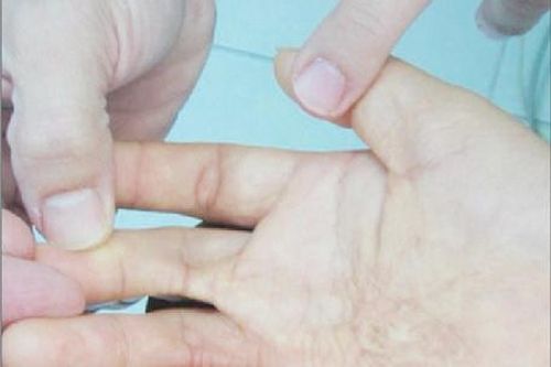 Tay quắp lại vì bỏng