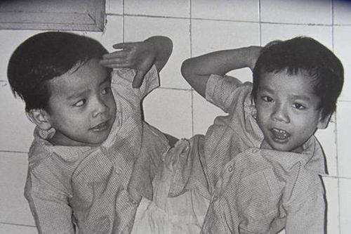 Những ca song sinh dính liền được phẫu thuật tách rời thành công tại Việt Nam