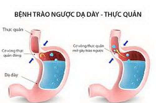 Bài thuốc trị trào ngược dạ dày - thực quản