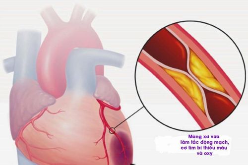 Cụ bà tử vong trên máy bay VNA: Phòng nhồi máu cơ tim thế nào?