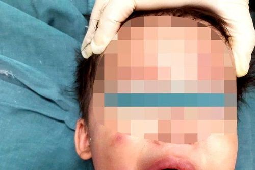 Cắn dây điện bé gái bị bỏng nặng, bất tỉnh tại chỗ
