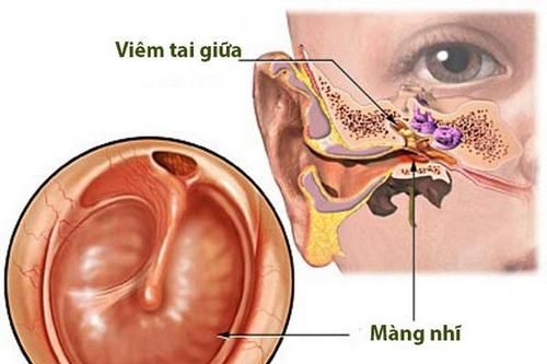 Chăm sóc trẻ bị viêm tai giữa
