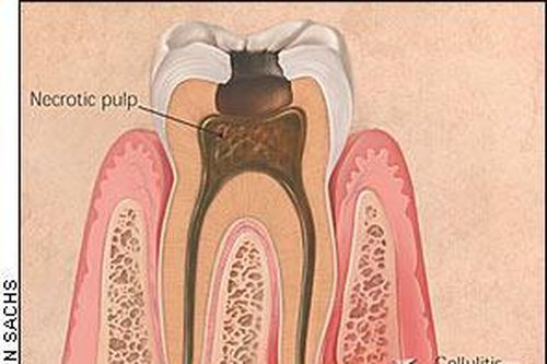 Viêm mô tế bào lan tỏa vùng hàm mặt – Biến chứng bệnh lý răng miệng