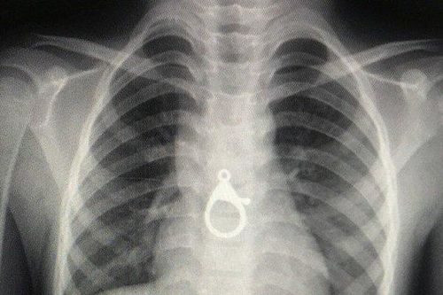 Bé trai 6 tuổi nhập viện cấp cứu vì nuốt phải móc khóa xe