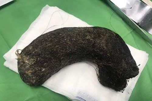 Búi tóc nặng 1kg ở trong dạ dày bé gái 11 tuổi