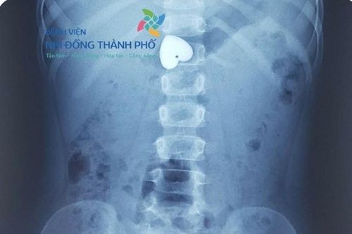 Cầm mặt dây chuyền hình trái tim chơi, bé gái 4 tuổi nuốt luôn vào bụng