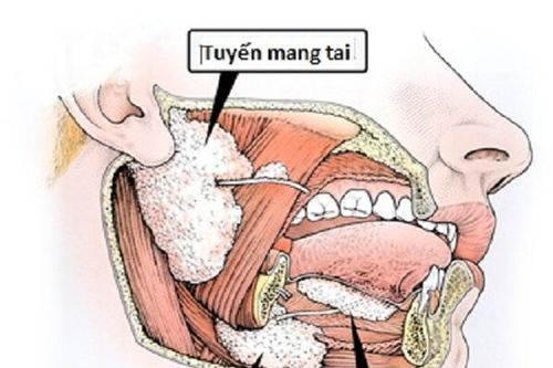 Ung thư tuyến nước bọt nguy hiểm như thế nào, chữa khỏi không?