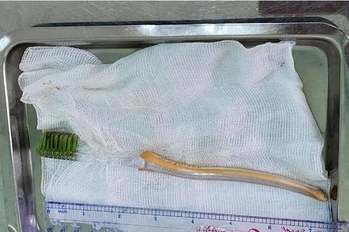 Bé trai 13 tuổi suýt chết vì nuốt bàn chải đánh răng vào bụng