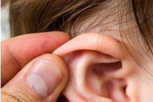Bé mắc viêm tai giữa, coi chừng bị giảm thính lực