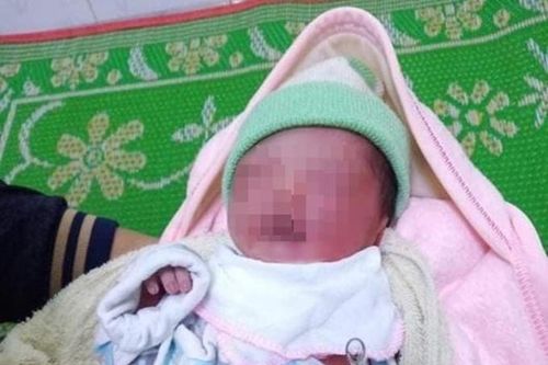 Bé gái sơ sinh bỏng nặng vì bị bỏ rơi trong rẫy giữa trời nắng nóng