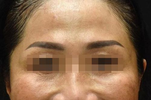 Độc tố botulinum có thể giúp trẻ hóa làn da, làm thon gọn khuôn mặt
