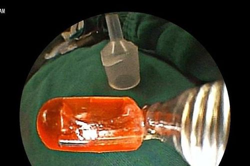 Hóc 'đầu đèn LED' trong đồ chơi, bé gái 10 tháng tuổi nguy kịch