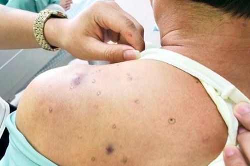 Người đàn ông tiểu ra máu sau khi bị ong đốt