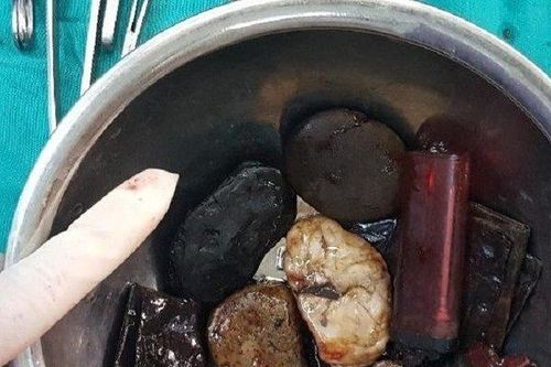 Rùng mình dạ dày người đàn ông chứa toàn bật lửa nguyên ga và sỏi lớn