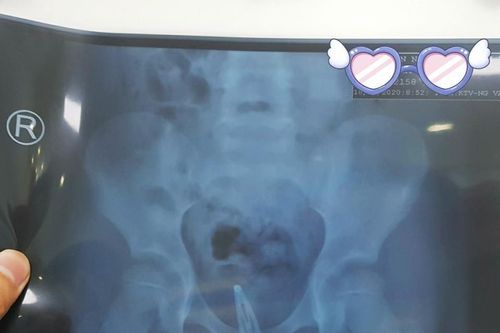 Kẹp tóc mắc kẹt trong cái âm đạo của bé gái suốt 3 tháng