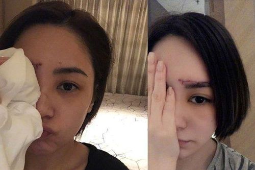 Chung Hân Đồng lần đầu đăng ảnh sau khi bị thương nặng