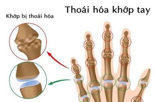 Đề phòng viêm thoái hóa khớp ngón tay