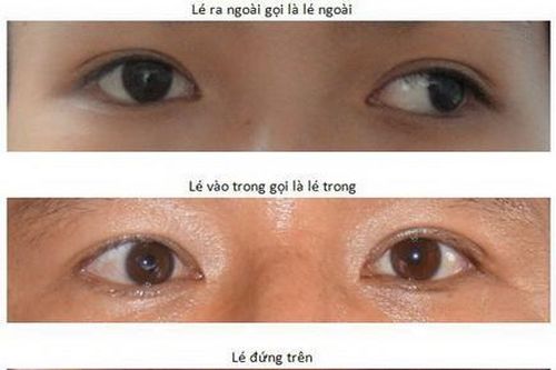 Lác mắt, khi nào cần mổ?