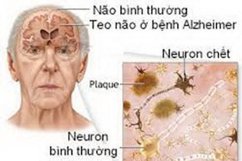 Phòng bệnh Alzheimer ở người lớn tuổi