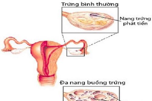 Bài thuốc trị bệnh buồng trứng đa nang