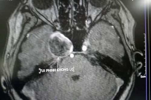 BVĐK TW Cần Thơ điều trị thành công phình động mạch não khổng lồ không cần phẫu thuật