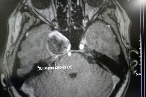 Cứu cụ bà có túi phình não khổng lồ mà không cần phẫu thuật