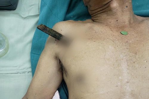 Ngã xe đạp, cụ ông 70 tuổi bị thanh gỗ dài 30cm đâm thủng phổi