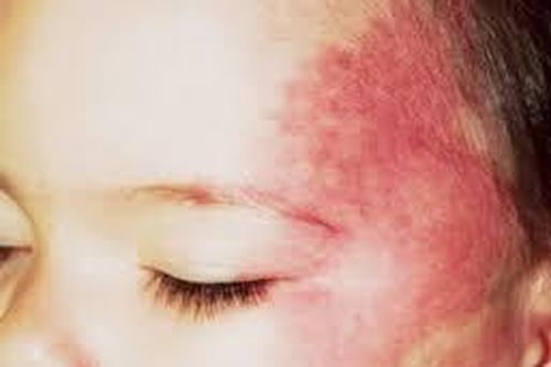 Các bất thường mạch máu hay gặp ở trẻ