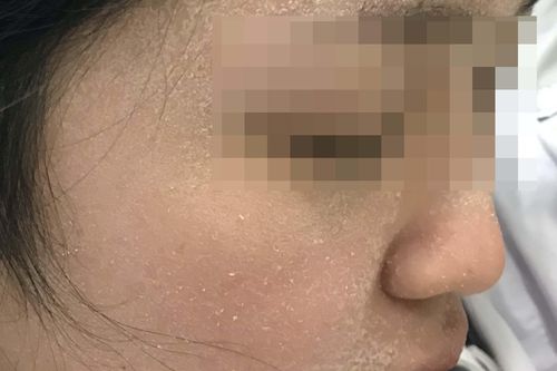 Làm gì khi da có 'phản ứng lạ' với thời tiết hanh khô?