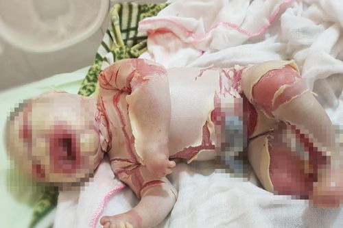 Bé sơ sinh bị lớp sừng trắng bao phủ khắp người