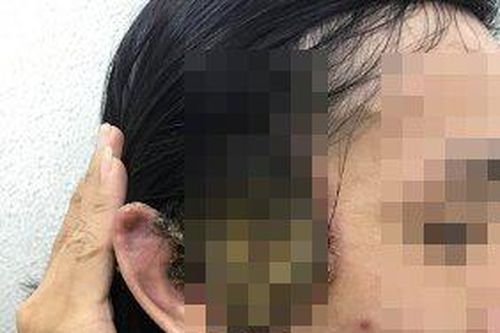 Số người khám bệnh lây qua đường tình dục ở BV Da liễu TP.HCM tăng cao