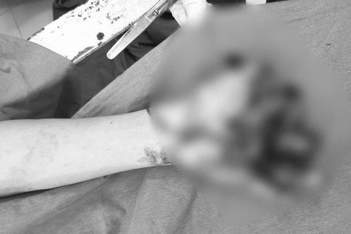 Lời cảnh tỉnh sau vụ cụt 3 ngón tay vì pin quạt phát nổ