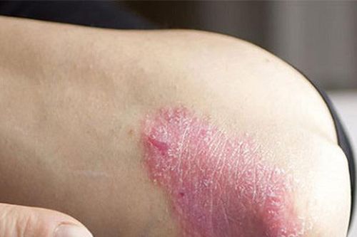 TPHCM: Bác sĩ da liễu tư vấn miễn phí về bệnh vảy nến