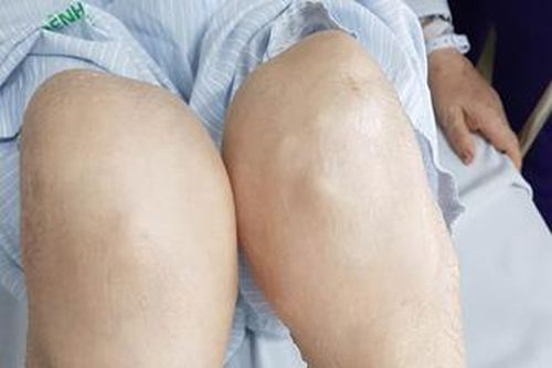 Báo động gia tăng tình trạng lạm dụng corticoid