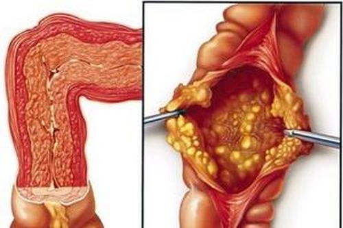 Cảnh giác với bệnh lao ruột