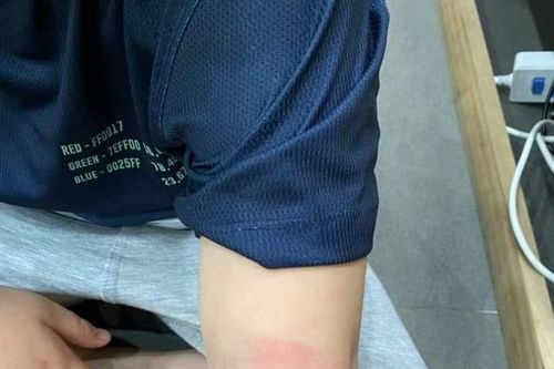 Xác minh làm rõ phản ánh học sinh lớp 1 nghi bị cô giáo đánh đến bầm tím cơ thể