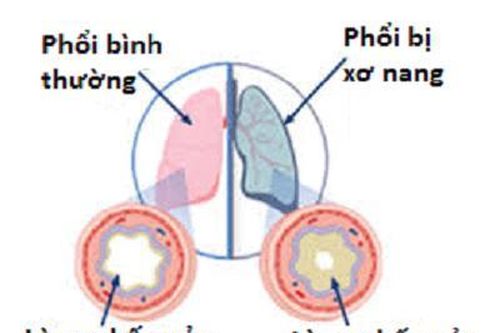 Thuốc cải thiện chức năng phổi ở bệnh nhân bị xơ nang