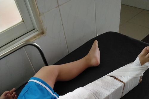 Đình chỉ công tác cô giáo làm gãy chân bé 4 tuổi ở Đồng Nai