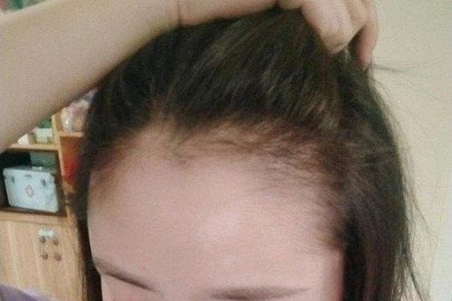 Cô gái mắc bệnh trọng vì rụng tóc quá nhiều